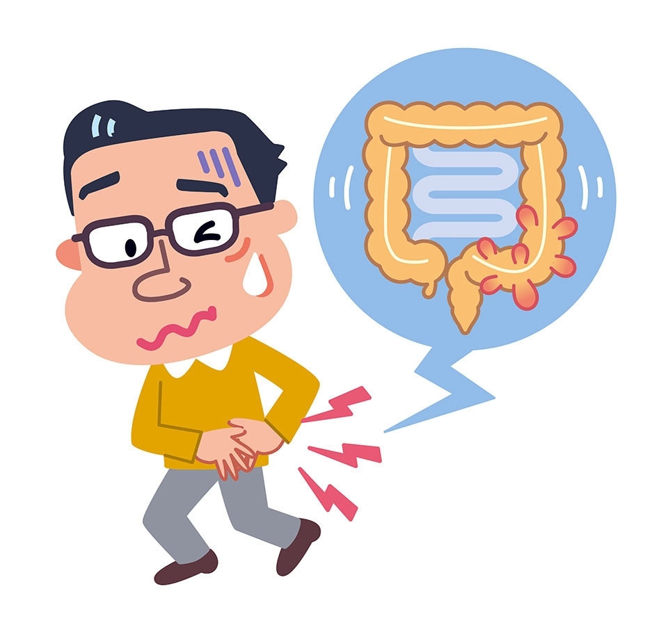 大腸憩室ってどんな病気？