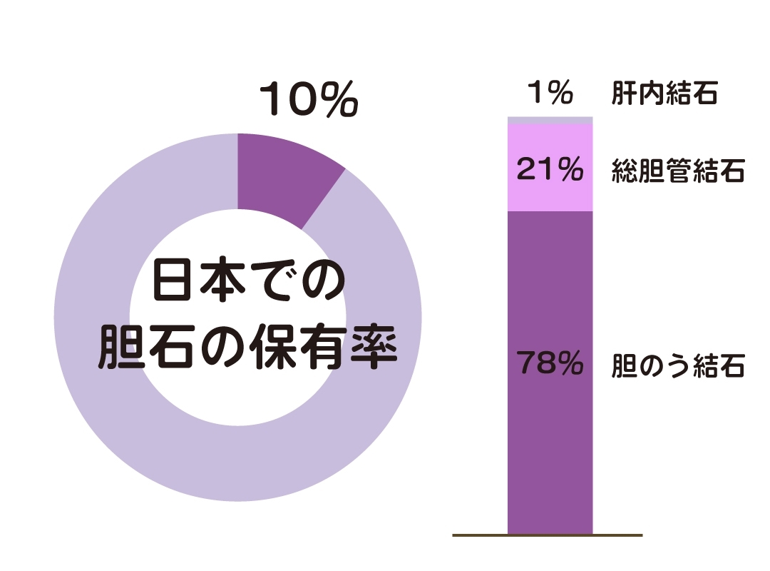胆のう結石ってどんな病気？