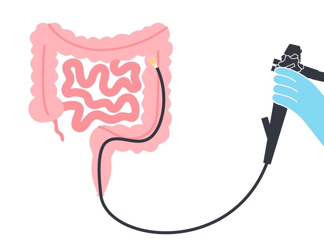 大腸内視鏡検査